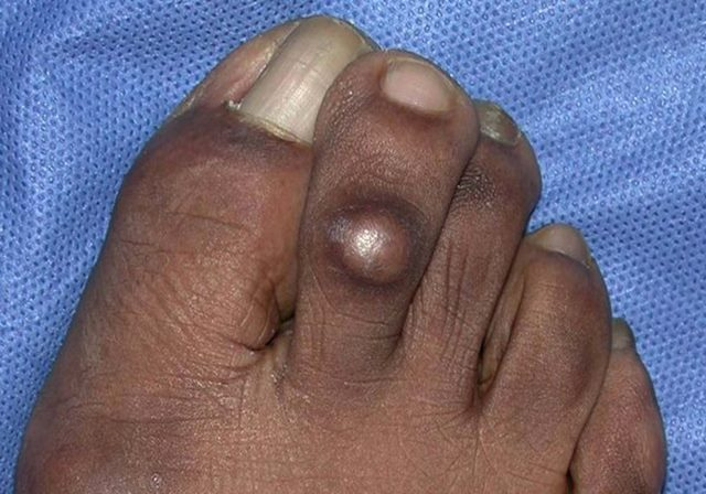Hard Corns & Calluses provided at home by a qualified foot health practitioner in Hertfordshire