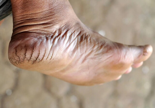 Cracked Heels provided at home by a qualified foot health practitioner in Hertfordshire