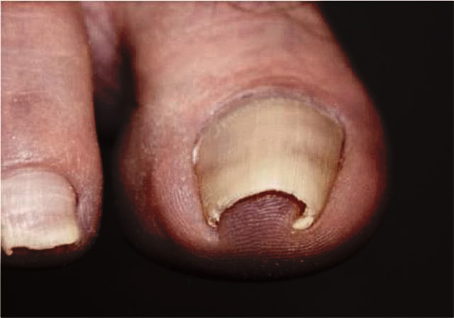 Involuted Toenail provided at home by a qualified foot health practitioner in Hertfordshire