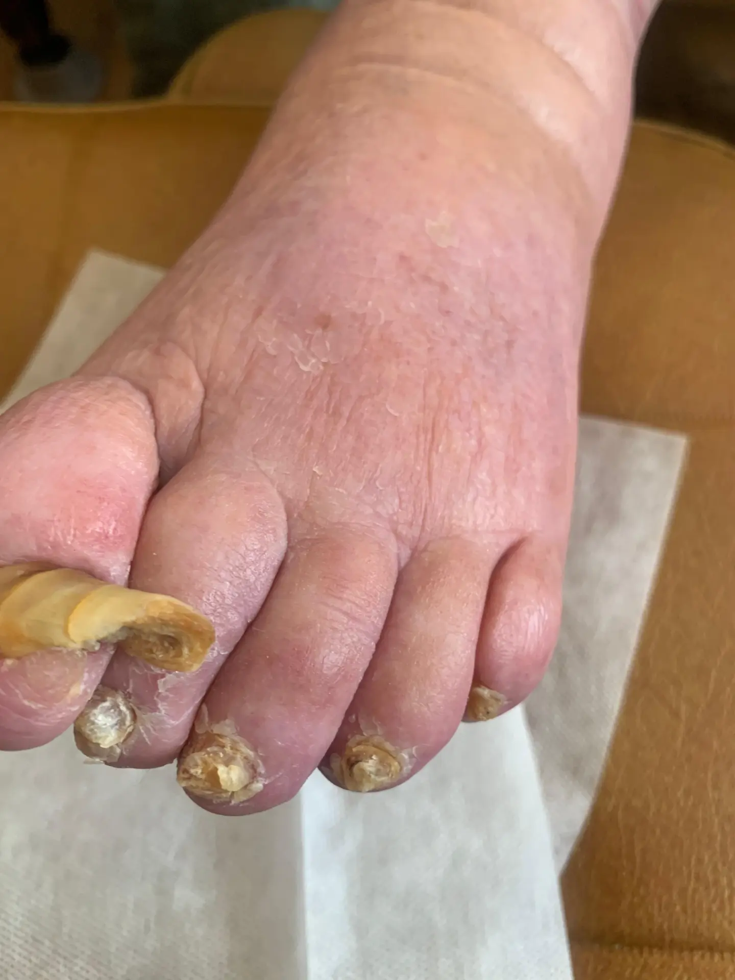 Before treatment: severely thickened, overgrown toenails on a client's foot during a home visit in Hertfordshire