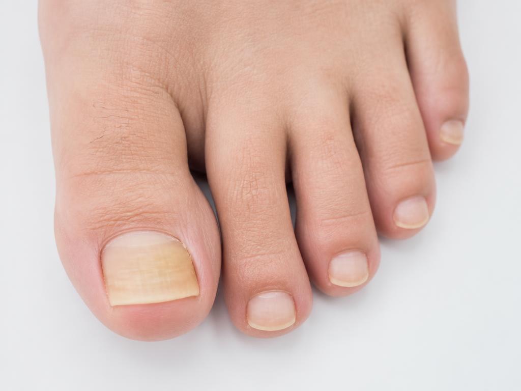 Thickened Toenail Treatment provided at home by a qualified foot health practitioner in Hertfordshire